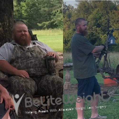 Weight Loss Surgery Before And After